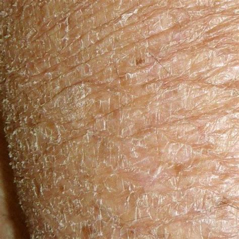 Xerosis Of Skin