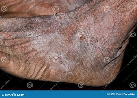 Dry, Cracked and Scaly Skin in Foot. Dermatitis Foot Stock Photo - Image of color, itchy: 233720840