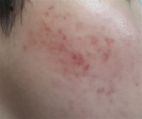 Acne Scars Blotchy Red at Joshua Allingham blog
