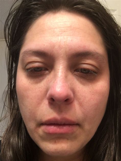 Face Swelling While Pregnant