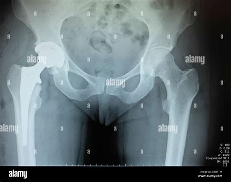 Hip replacement hi-res stock photography and images - Alamy