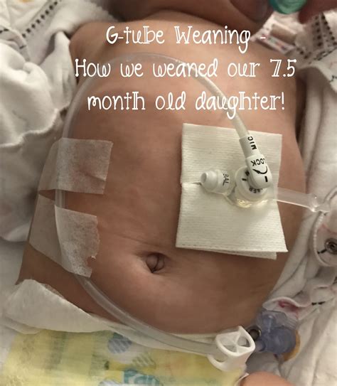 G Tube On Baby at Brad Schaffer blog