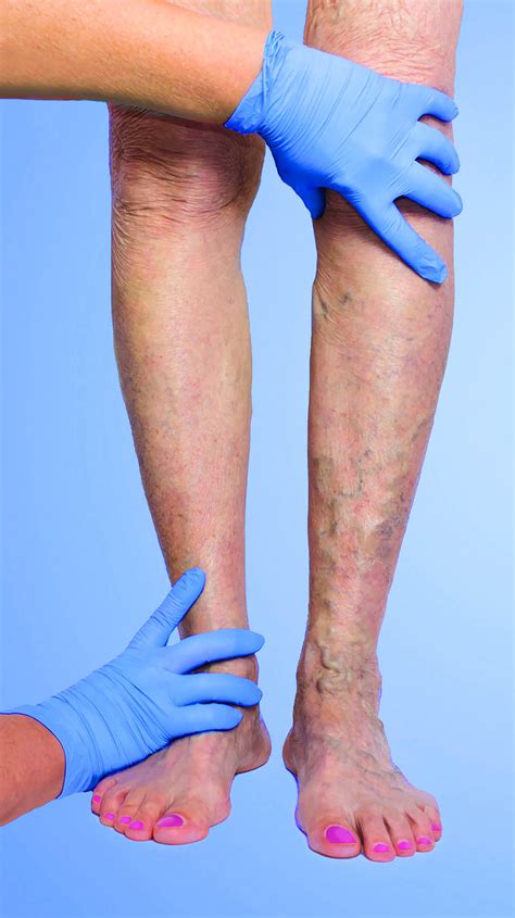 How To Avoid Getting Varicose Veins - Memberfeeling16