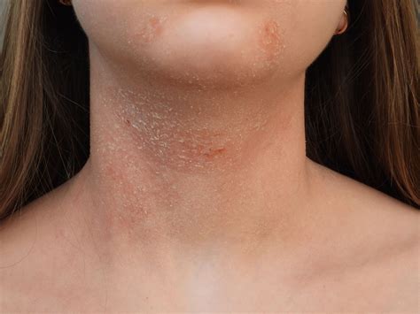 Dermatitis Por Estres Fotos