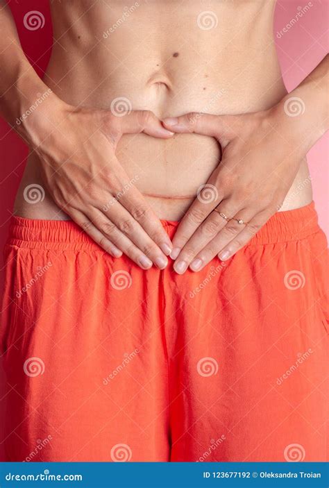 C Section Cesarean Operation Heal after Mother Making Heart with Arms Postpartum Stock Photo ...