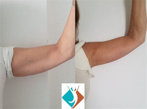 Surgical Arm Fat Removal at Corazon Stafford blog