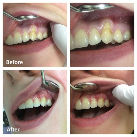 Dental Gum Graft Material at Michael Hatfield blog
