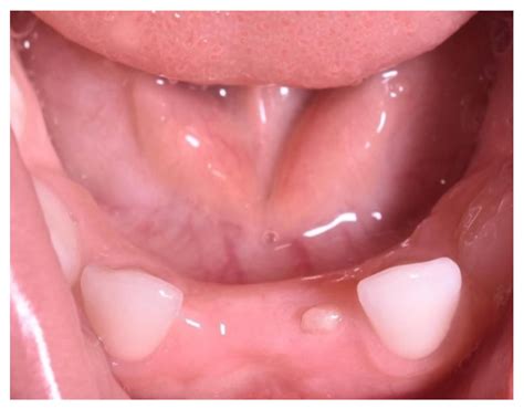 Natal and Neonatal Teeth: A Case Report and Mecanistical Perspective