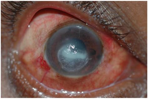 Bacterial Corneal Ulcer