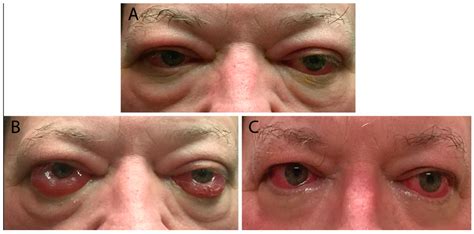 Hypothyroidism Red Eyes