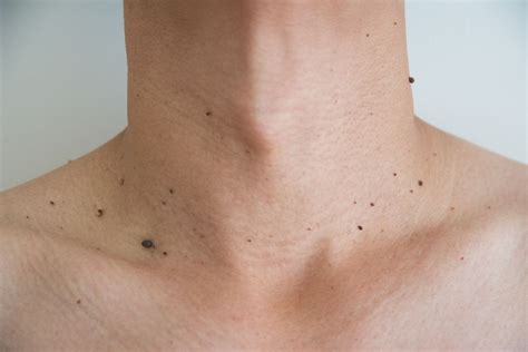Skin Tag Removal - Markham | Experts For Clear & Healthy Skin
