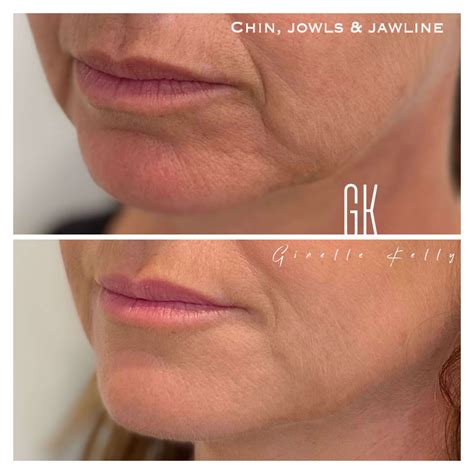 Fillers For Jowls