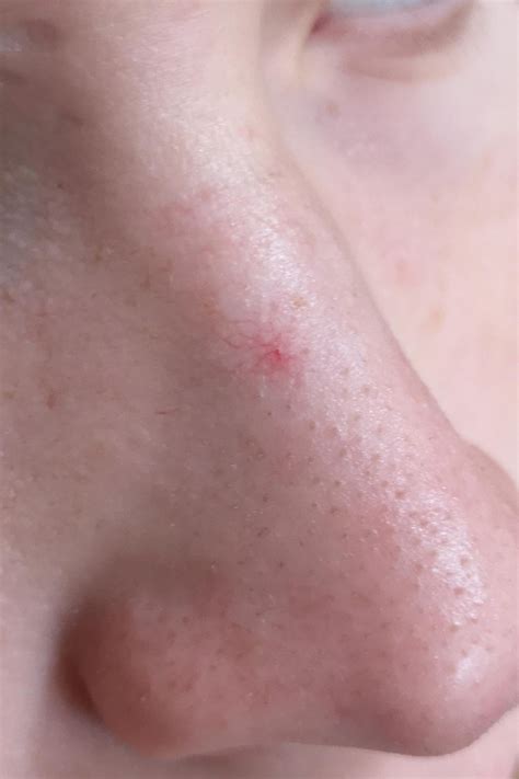 Red spot on nose not going away? : r/Dermatology