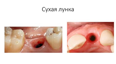 Заживление лунки после удаления зуба - презентация онлайн