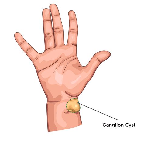 Hand & Wrist Surgery in Leeds - Skin Surgery Clinic
