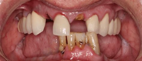 Dental Implants | Dentist Greer SC | Brushy Creek Dental Partners