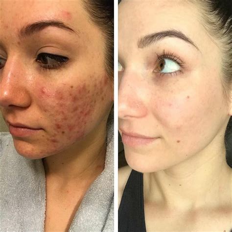 Spironolactone: Uses, Side Effects, a Comprehensive Guide