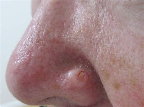 BCC on The Nose – Basal Cell Carcinoma Picture | Mr Tehrani – Mohs Surgeon