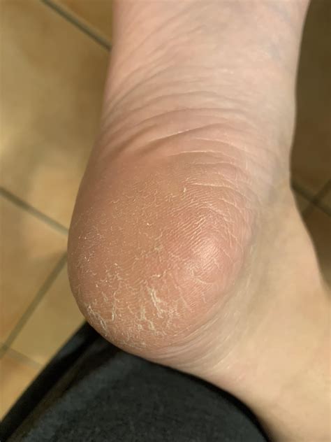 dry skin or athlete's foot / Moccassin-type tinea pedis? : r/DermatologyQuestions