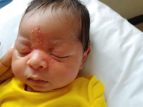 Newborn’s rash involves eyes and nose