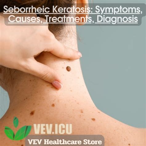 Seborrheic Keratosis: Symptoms, Causes, Treatments, Diagnosis