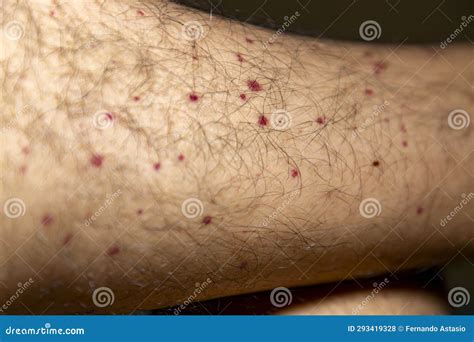 Vasculitis. Vasculitis in Legs. Small Red or Purple Spots. Rare Disease. Stock Photo - Image of ...