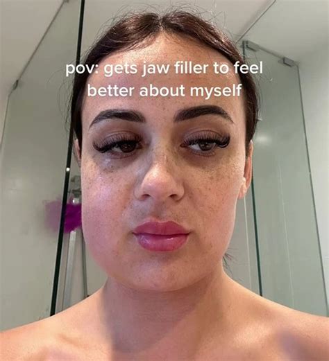 I got jaw filler to feel better about myself — it ruined my life