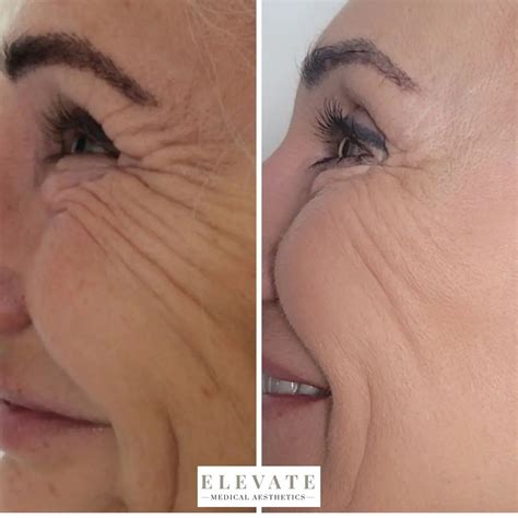 What Is Microneedling With Radio Frequency at Georgia Challis blog