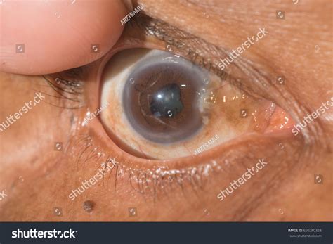 Persistent Pupillary Membrane