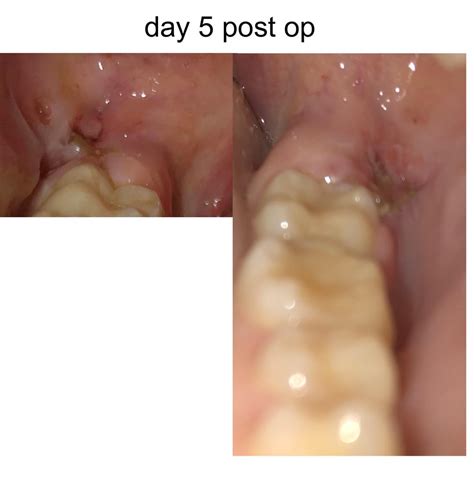 1 month of my wisdom teeth removal healing process (PICTURES) : r/wisdomteeth