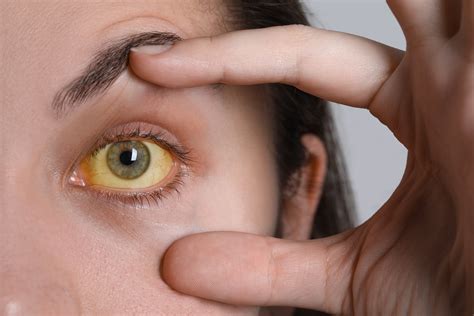 jaundice yellow eyes skin — HealthIntell