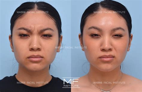 Forehead Wrinkles & Frown Lines Before and After Pictures Case 1174 | San Francisco, CA | Mabrie ...