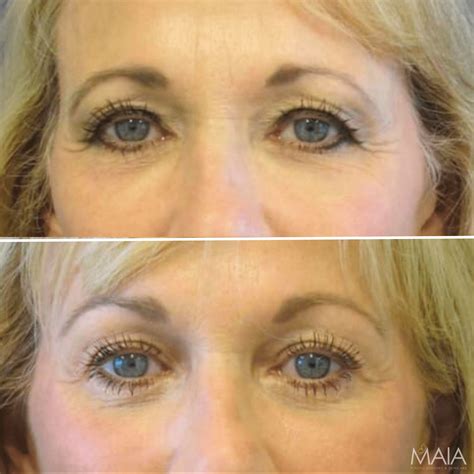Brow Lift | Maia Plastic Surgery