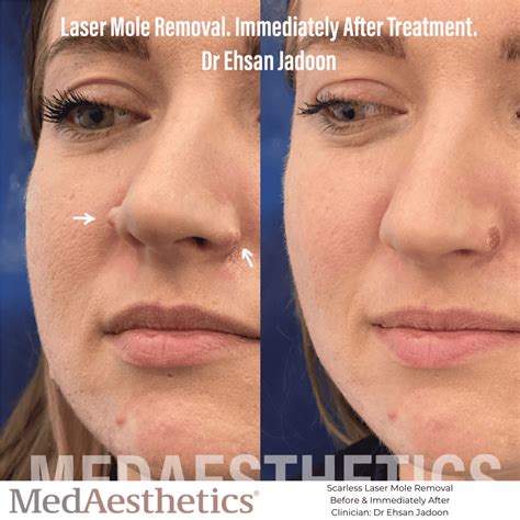 Laser Mole Removal Perth | MedAesthetics