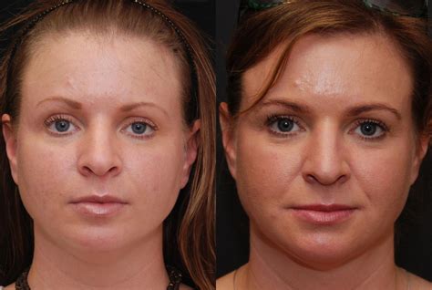 Laser Light Lipo Before And After at Wallace Yang blog