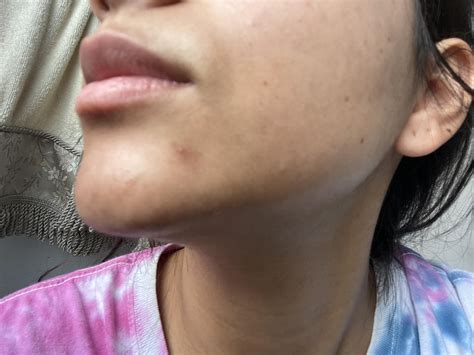 [Skin Concern] Post inflammatory hyperpigmentation (I think). See that dark spot on my chin? It ...
