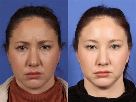 Botox Before And After Crows Feet
