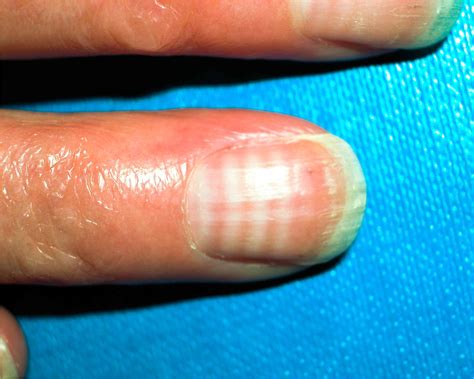 Nail Abnormalities: Common Types, Causes & Prevention