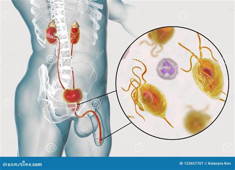 Trichomonas Infection (Trichomoniasis) Icon. Trendy Flat Vector ...
