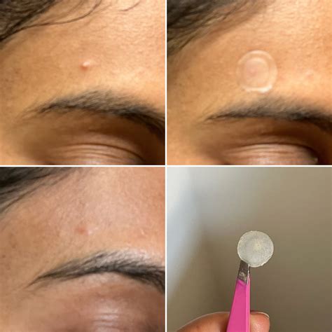 Good Molecules Pimple Patch Review With Photos | POPSUGAR Beauty UK