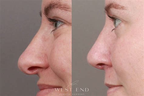 Septoplasty Only Before And After