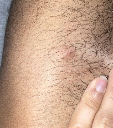 pea-sized firm lump under skin on upper inner thigh : r/medical_advice