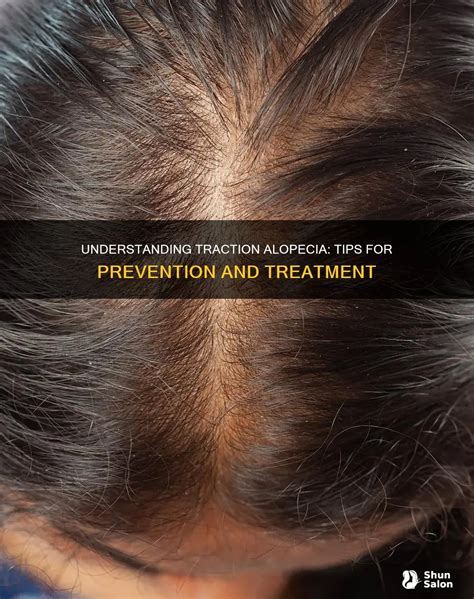 Understanding Traction Alopecia: Tips For Prevention And Treatment | ShunSalon