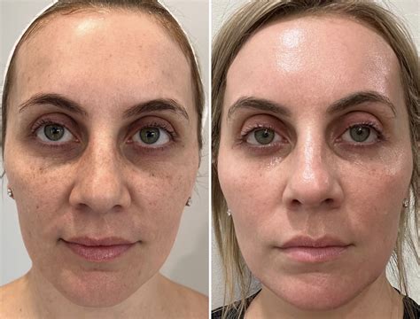 Laser Facial Good Or Bad at Paul Bravo blog