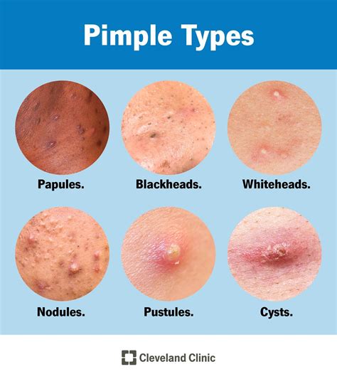 Pimples causes vs acne types treatment – Artofit