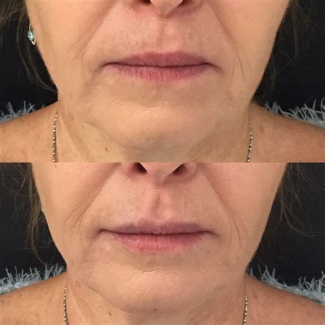 Jowl Filler Before And After | Thebrokensealblog