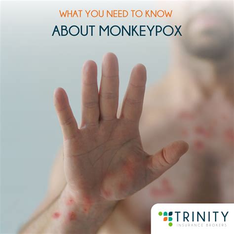 What You Need to Know about Monkeypox – Trinity Insurance and Reinsurance Brokers, Inc.