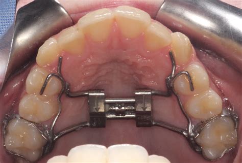 Different Types Of Palate Expanders Expander And Braces
