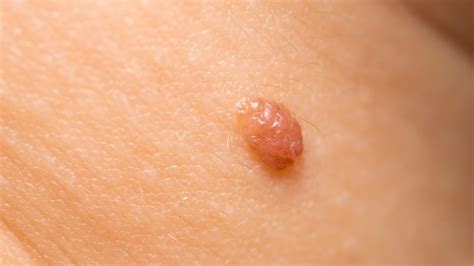 growths #5637385 | Clipart Library