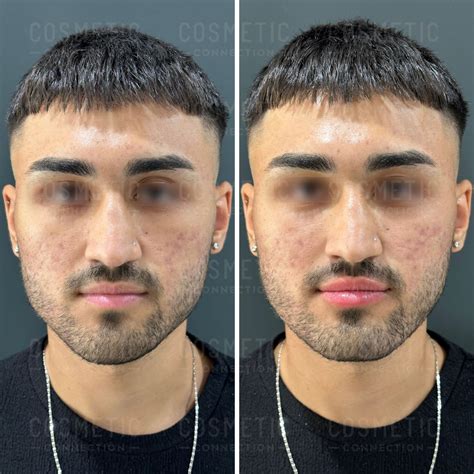 Asymmetrical Face Causes